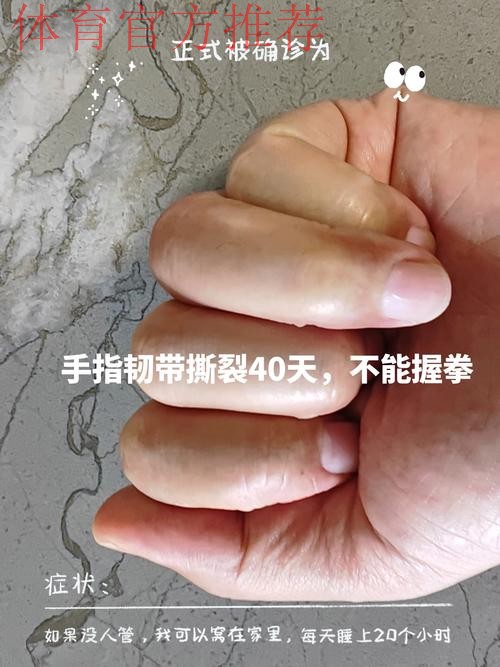 Siegel：康查尔左手拇指尺侧副韧带撕裂，三周后复查