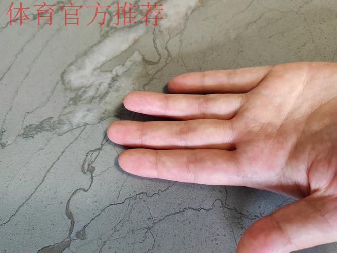 Siegel：康查尔左手拇指尺侧副韧带撕裂，三周后复查